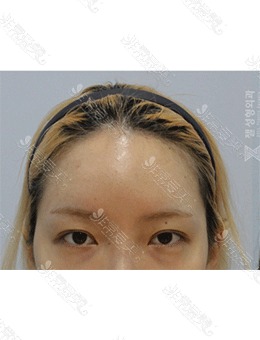 韩国Zell整形额头缩小手术图片，额头缩小术会留疤吗一看就知道！_术前