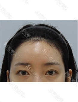 韩国Zell整形额头缩小手术图片，额头缩小术会留疤吗一看就知道！