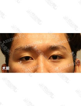 韩国德丽珍整形外科男士双眼皮，术后颜值就这么上来了！_术前