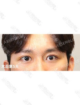 韩国德丽珍整形外科男士双眼皮，术后颜值就这么上来了！