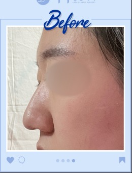 韩国乐日lara整形医院隆鼻术前术后图，3d打印隆鼻技术真是牛！_术前