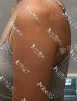 韩国德丽珍医院手臂+背部吸脂术前VS术后第4个月，对比很惊艳！_术前