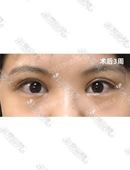 -韩国德丽珍医院全切双眼皮+提肌+开内眼角术前VS术后3周，有被美到！