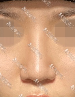 韩国乐日lara整形3d打印隆鼻+鼻头缩小+鼻小柱矫正术前VS术后2个月，变化太大了！_术后