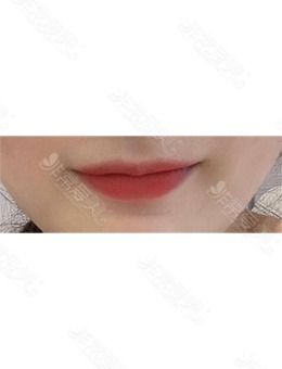 韩国嘴唇整形哪家好?分享欧艾尔ONAIR整形外科玻尿酸丰唇案例!