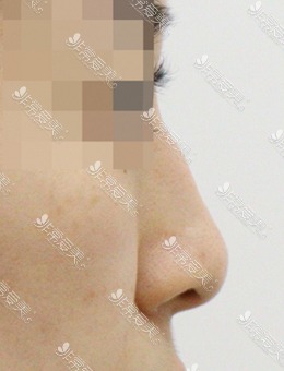 驼峰鼻矫正前后图片，术后据反馈确实没有后遗症！