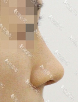 驼峰鼻矫正前后图片，术后据反馈确实没有后遗症！_术后