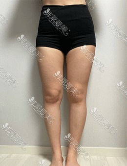 -在韩国宝士丽医院做了腿部吸脂术，拥有美腿就是这么简单!