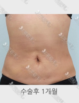 腹部吸脂韩国推荐哪家医院？ 看看这家吸脂手术评价好的医院吧！