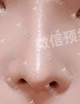 韩国德丽珍医院鼻综合术前术后3个月对比，精致美鼻你也可以拥有！