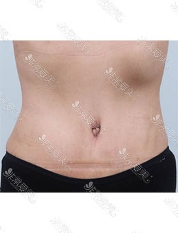 -韩国byulstar整形外科腹壁成形手术，重现完美体型！