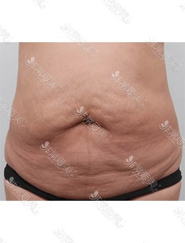 -韩国byulstar整形外科改善腹部松弛，大肚腩也可以变成小蛮腰！