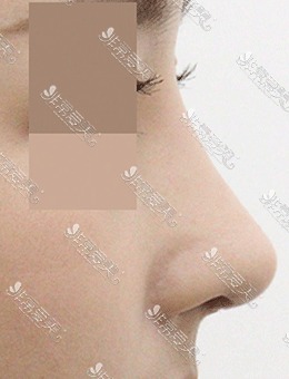 韩国AND整形外科驼峰鼻矫正术前术后对比，鼻型太好看了！_术后