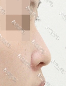 -在韩国AND整形外科做的鼻子，确实很惊艳！