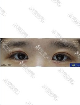 -韩国IOU整形医院切开双眼皮+眼睑下垂修复术后13天照片分享！