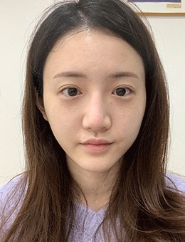 韩国KOKO整形医院鼻部+脂肪填充+颧骨整形手术,全脸打造惊艳！
