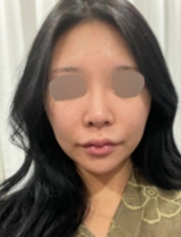 韩国鼻修复医院推荐爱乐整形外科,鼻修复真人案例绝美!