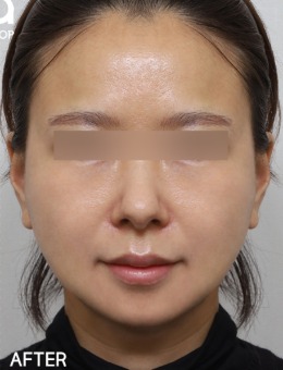 韩国爱她整形外科迷你拉皮手术对比图