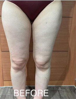 -韩国宝士丽医院大腿+臀部吸脂，术后腿形很美！