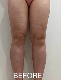 -韩国宝士丽医院腿部吸脂，拥有紧致修长的筷子腿！