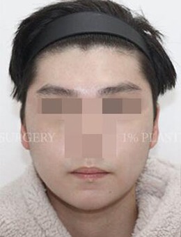 -韩国1%整形外科男士面部轮廓整形，个人满意度超高！