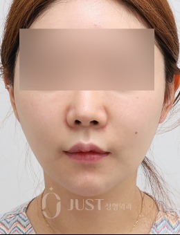 在韩国JUST整形做了双下巴埋线提升，脸型精致了很多！