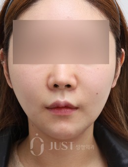 在韩国JUST整形做了双下巴埋线提升，脸型精致了很多！