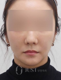 韩国JUST整形外科面部埋线提升，一次还你青春！_术后