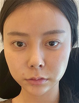 韩国note整形颧骨修复+眼鼻修复恢复照片分享
