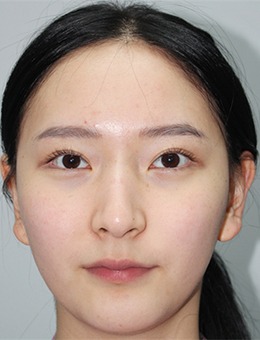 现代美学五官精修案例：眼部全切修复+外眼角下至+隆鼻+颧骨修复_术前