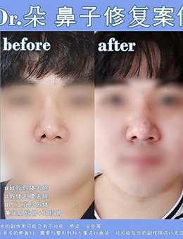 -韩国鼻子修复医院中dr.朵整形医院做鼻修复很出名，看对比就知道！