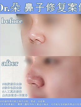 韩国鼻子修复医院中dr.朵整形医院做鼻修复很出名，看对比就知道！