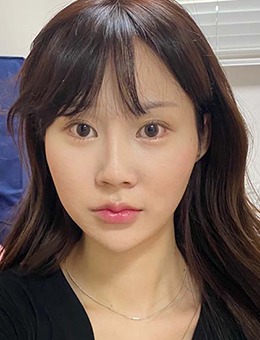 -韩国TS整形鼻综合+轮廓手术全脸整形对比照