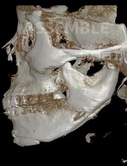 敢给你看下颌角截骨前后骨骼CT，说明德丽珍整形是真有实力！_术前