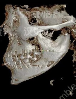 敢给你看下颌角截骨前后骨骼CT，说明德丽珍整形是真有实力！_术后