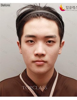-韩国TopClass整形外科男士眼鼻整形，术后变身帅气小哥哥！
