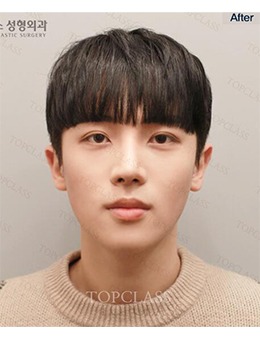 -韩国TopClass整形外科男士眼鼻整形，术后变身帅气小哥哥！