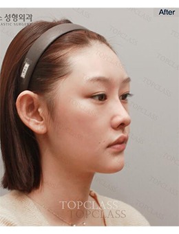 -韩国topclass医院官网鼻整形+脂肪填充案例公开,气质大变样!