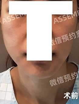 韩国德丽珍医院下颌角+T截骨术前VS术后1个月，脸型太好看了！