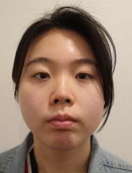 韩国DA整形双眼皮+隆鼻+轮廓整形+凸嘴手术对比图分享！
