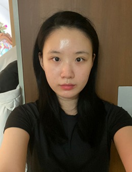韩国DA整形医院做眼鼻整形和全脸脂肪填充之后华丽变身!