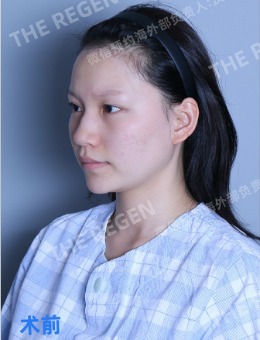 -韩国德丽珍整形医院这组隆鼻+颧骨整形对比图真美炸了！！！