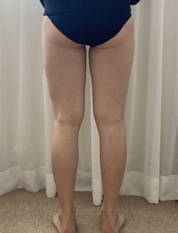 韩国宝士丽医院臀部+大腿吸脂术，术后身材太美了！_术前