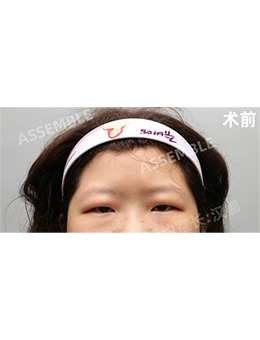 韩国德丽珍整形全切双眼皮+提肌矫正+去眼部脂肪对比照_术前