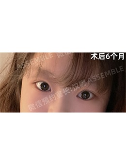 韩国德丽珍整形全切双眼皮+提肌矫正+去眼部脂肪对比照