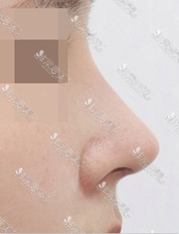 在韩国AND整形外科做的鼻子，确实很惊艳！
