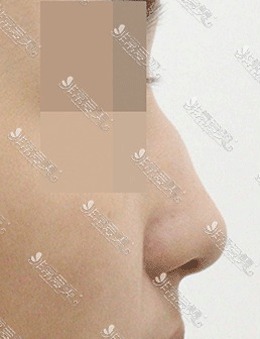 韩国AND整形外科驼峰鼻矫正术前术后对比，鼻型太好看了！_术前