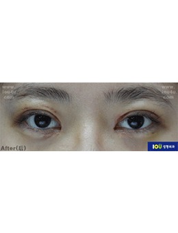 韩国IOU医院眼修复术前术后13天对比，技术真的很厉害！