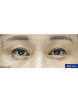 韩国IOU整形外科双眼皮修复案例,双眼皮宽改窄之后美爆了！_术后