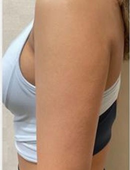 韩国宝士丽医院手臂吸脂术前术后2个月对比，真的细了很多！_术前